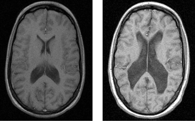 Слева — мозг здорового человека; справа —
