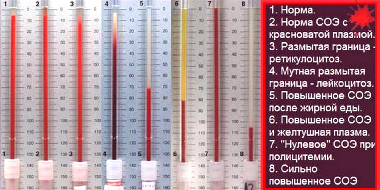 Что означает соэ в крови у мужчин. Прибор Панченкова СОЭ. СОЭ метод Панченкова норма. СОЭ В крови по методу Панченкова. СОЭ 11мм.