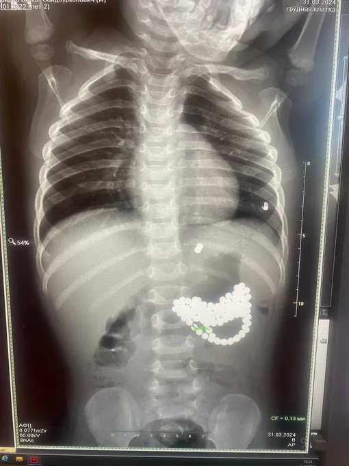 Рентгенограмма мальчика, на которой видны инородные предметы в желудке ребенка
