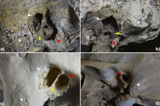 Лекари 5300 лет назад делали операции на ухе каменными инструментами — удивительное фото