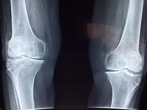 Рентген коленных суставов