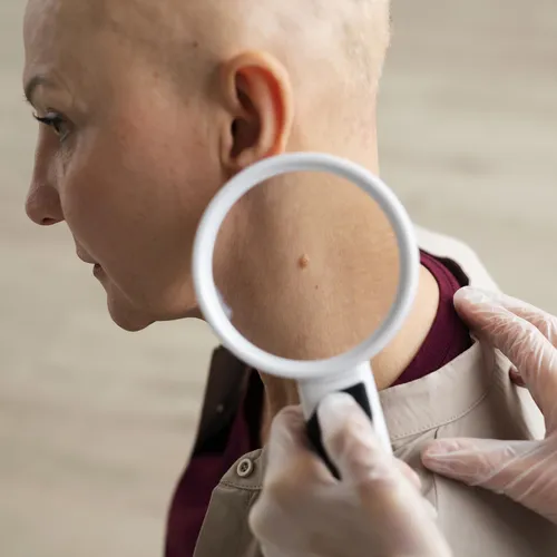 Названы признаки самого агрессивного рака кожи: что нужно знать