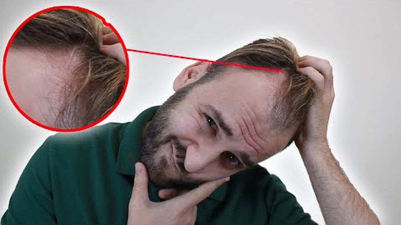 Что вызывает облысение у мужчин?