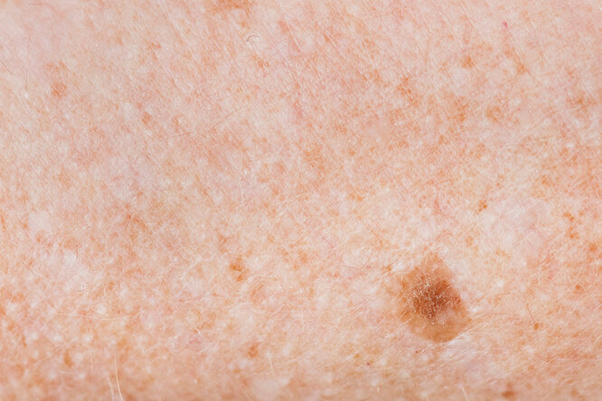 Как по родинкам определить, может ли у вас быть рак кожи?
