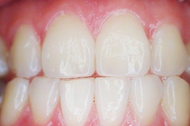 Сколько надо времени, чтобы эмаль зуба восстановилась