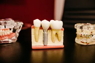 Зубные импланты для пожилых: зачем нужны и как выбрать