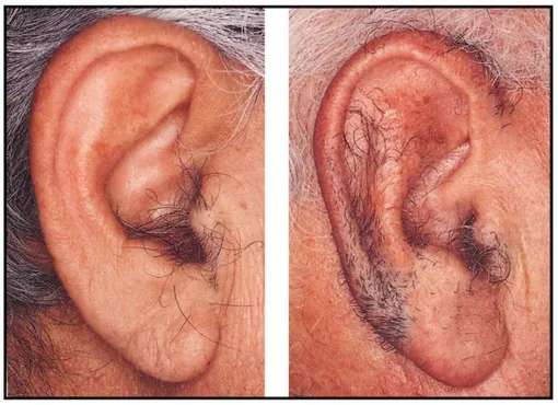 Пример «волосков козелка». Так данный тип волос на ушах назвали из-за схожести пучков волос с бородкой козла.