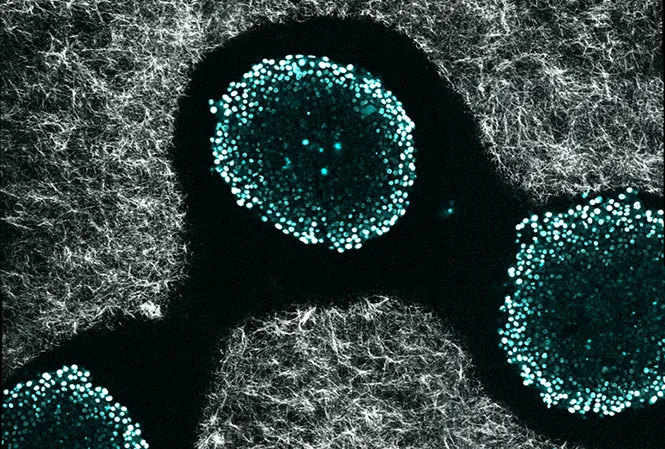 Три кластера раковых клеток (бело-голубые точки), вживленные в трехмерную матрицу из белковых нитей (белые полоски). На таких маленьких опухолях изучают поведение раковых клеток и метастазы.ALEXANDRE ALBANESE, JEFFREY WYCKOFF, SANGEETA BHATIA