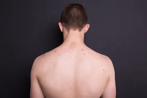 Прыщи на спине очень распространены у подростков и молодых людей. Около 95% людей в возрасте от 11 до 30 лет страдают от акне на разных частях тела.
