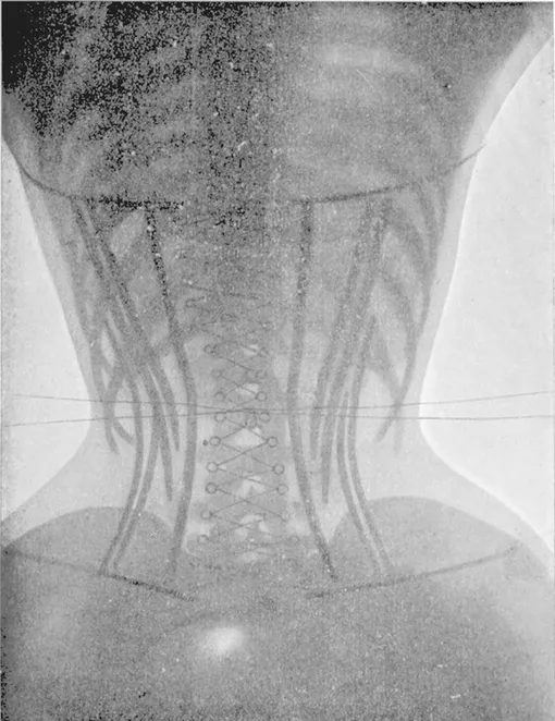 Корсет на рентгеновском снимке