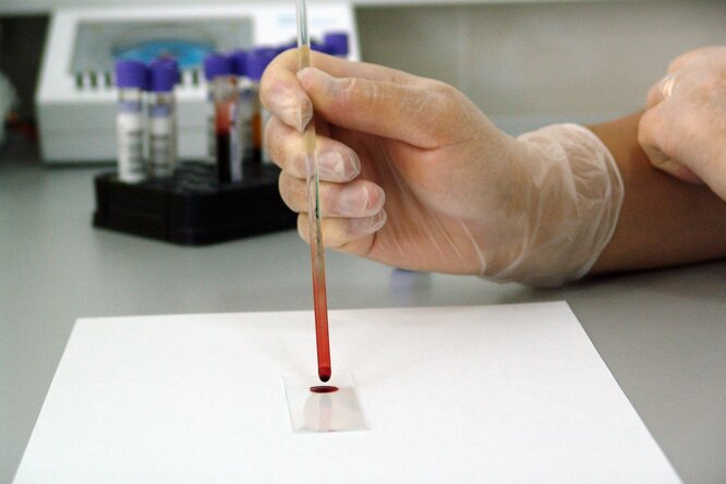 Как определить анемию без анализа крови?
