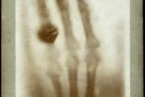 Фотография, удостоившаяся Нобелевской премии: первый в мире рентгеновский снимок
