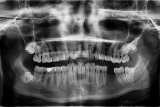 Считаются ли зубы костями?