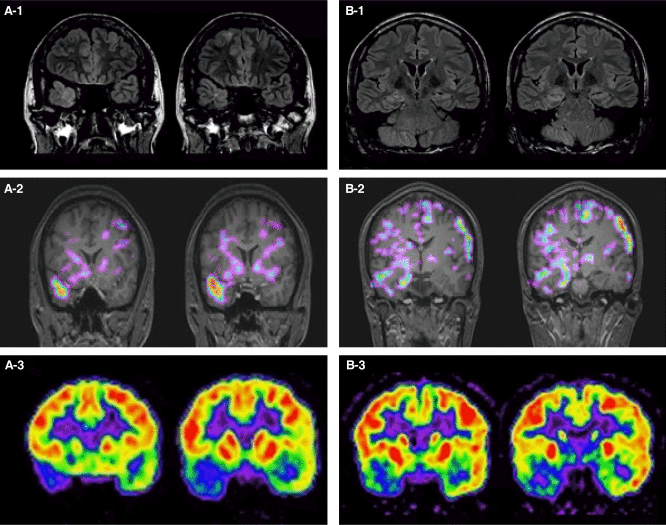 Как выглядит МРТ мозга при шизофрении